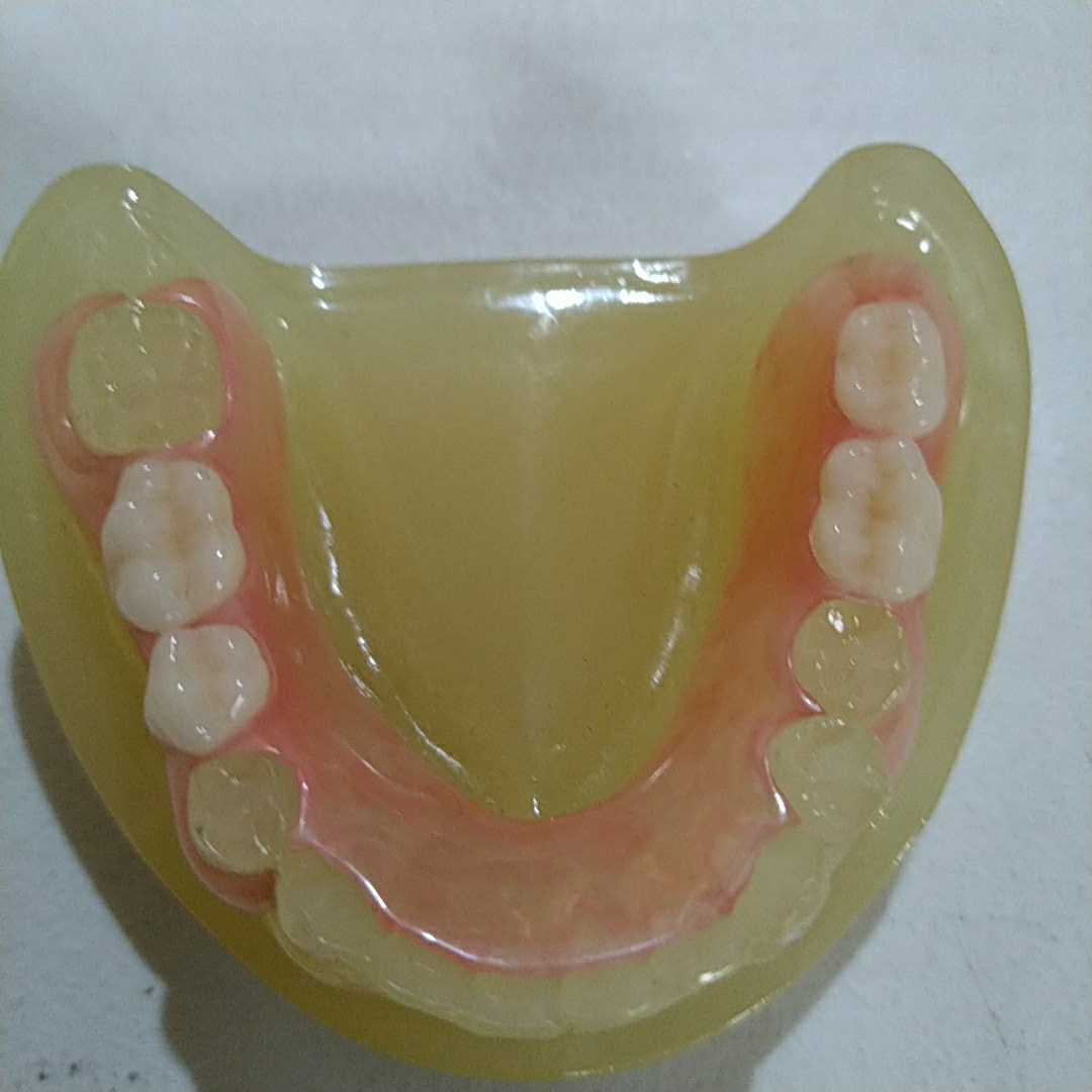 義歯 歯科 入れ歯 ノンクラスプデンチャー スマイルデンチャー